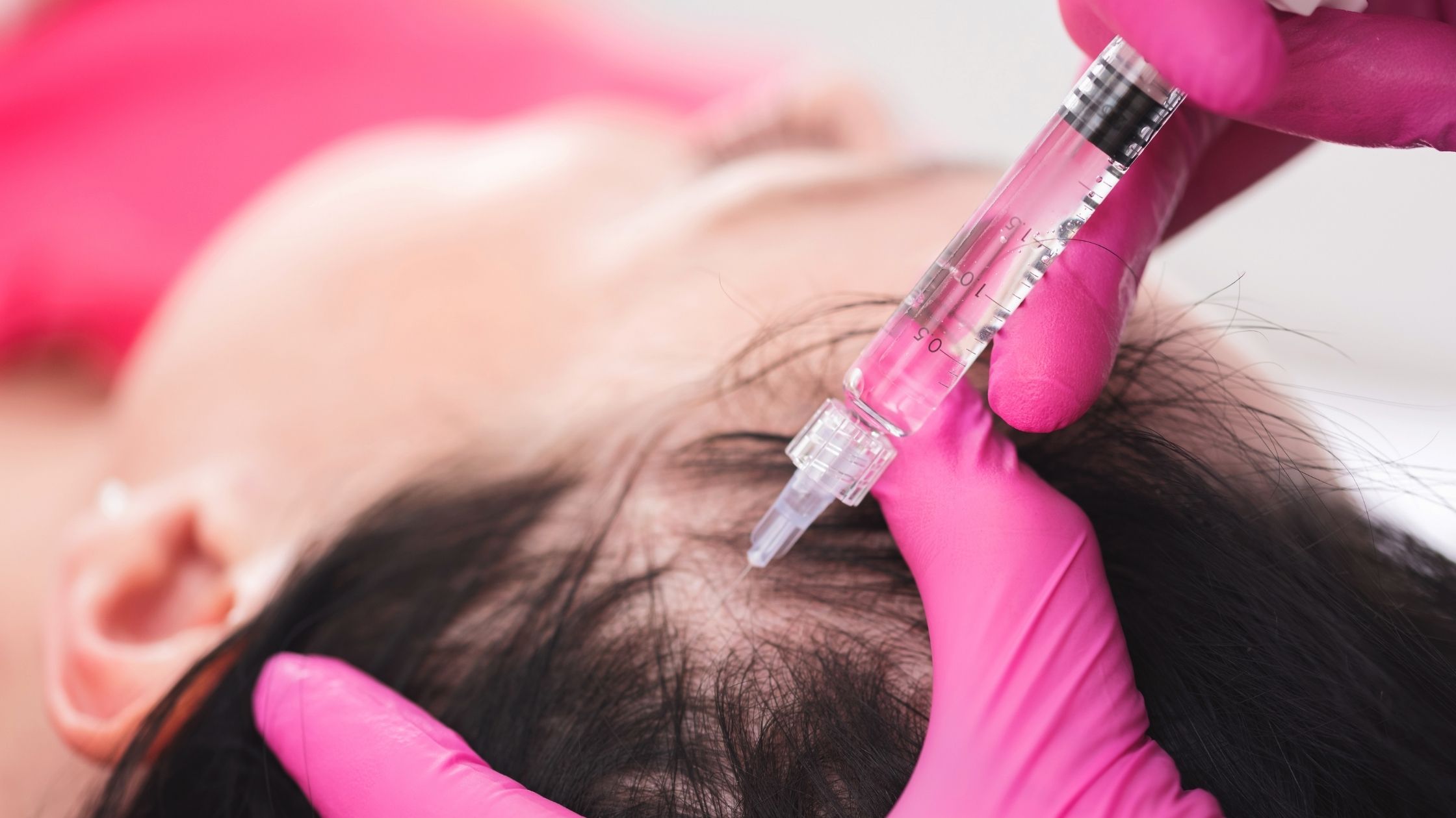 PRP Treatment for Hair Loss Pre and Post Treatment