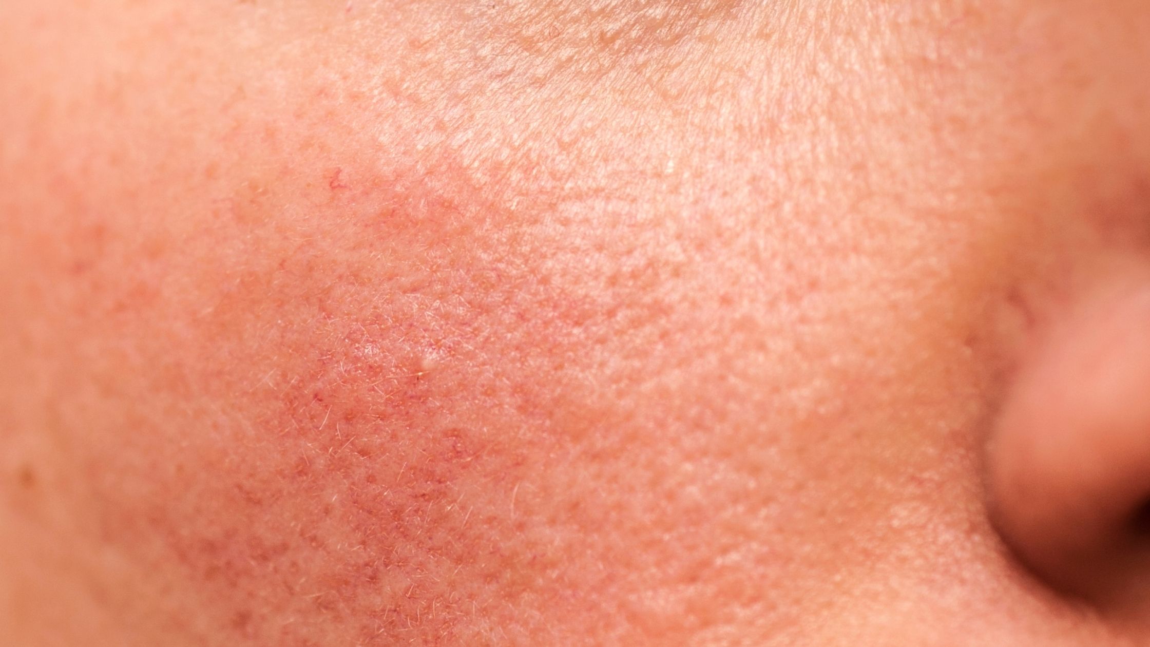 treat Rosacea