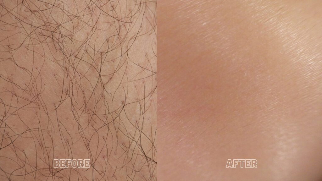 laser hair removal - before and after