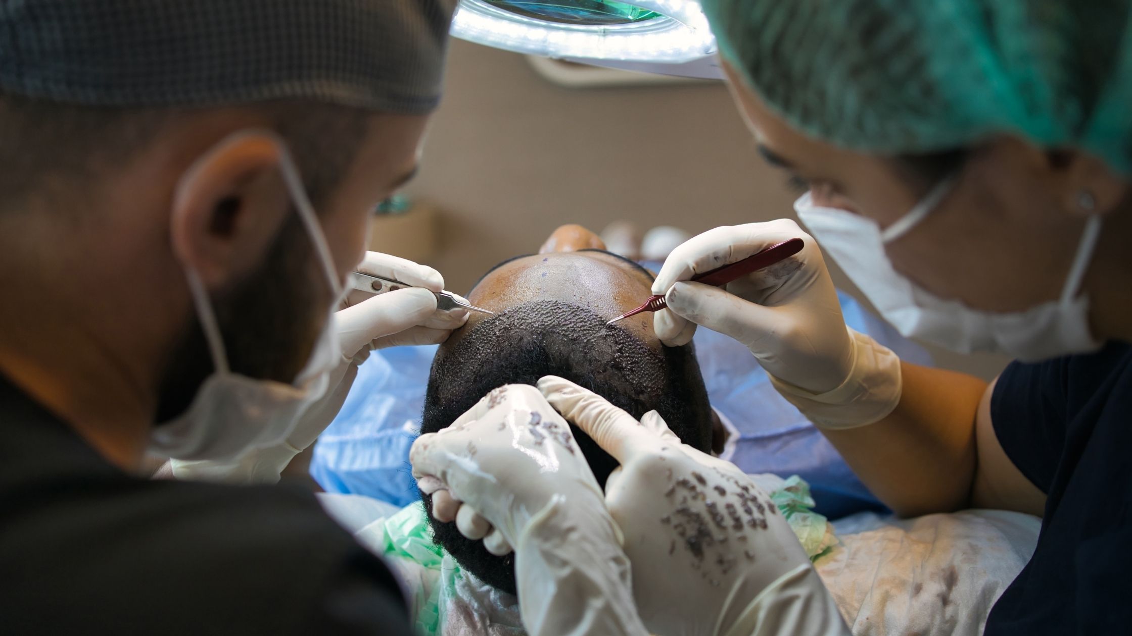 What is Hair Transplant Cost in Bangalore?  | Dermatologist