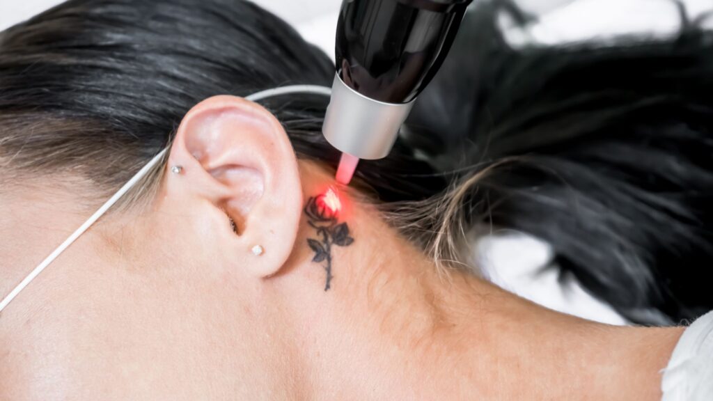 Laser Tattoo Removal in Bangalore: Cost, Advantage & Aftercare 