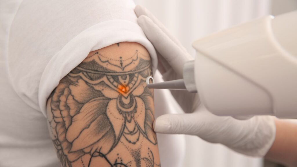 LASER TATTOO REMOVAL  Bare Element