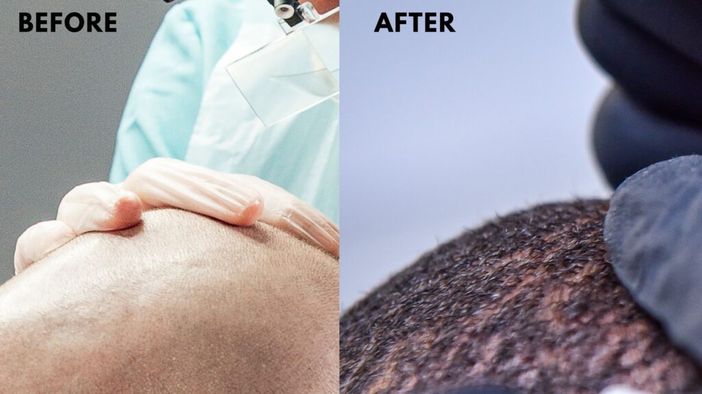 Scalp Micropigmentation Before & After