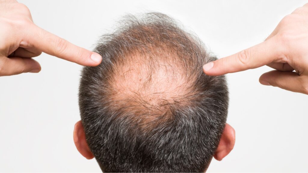 Genetic Hair Loss Treatment | Svenson