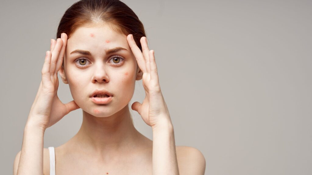 Acne treatment for teens
