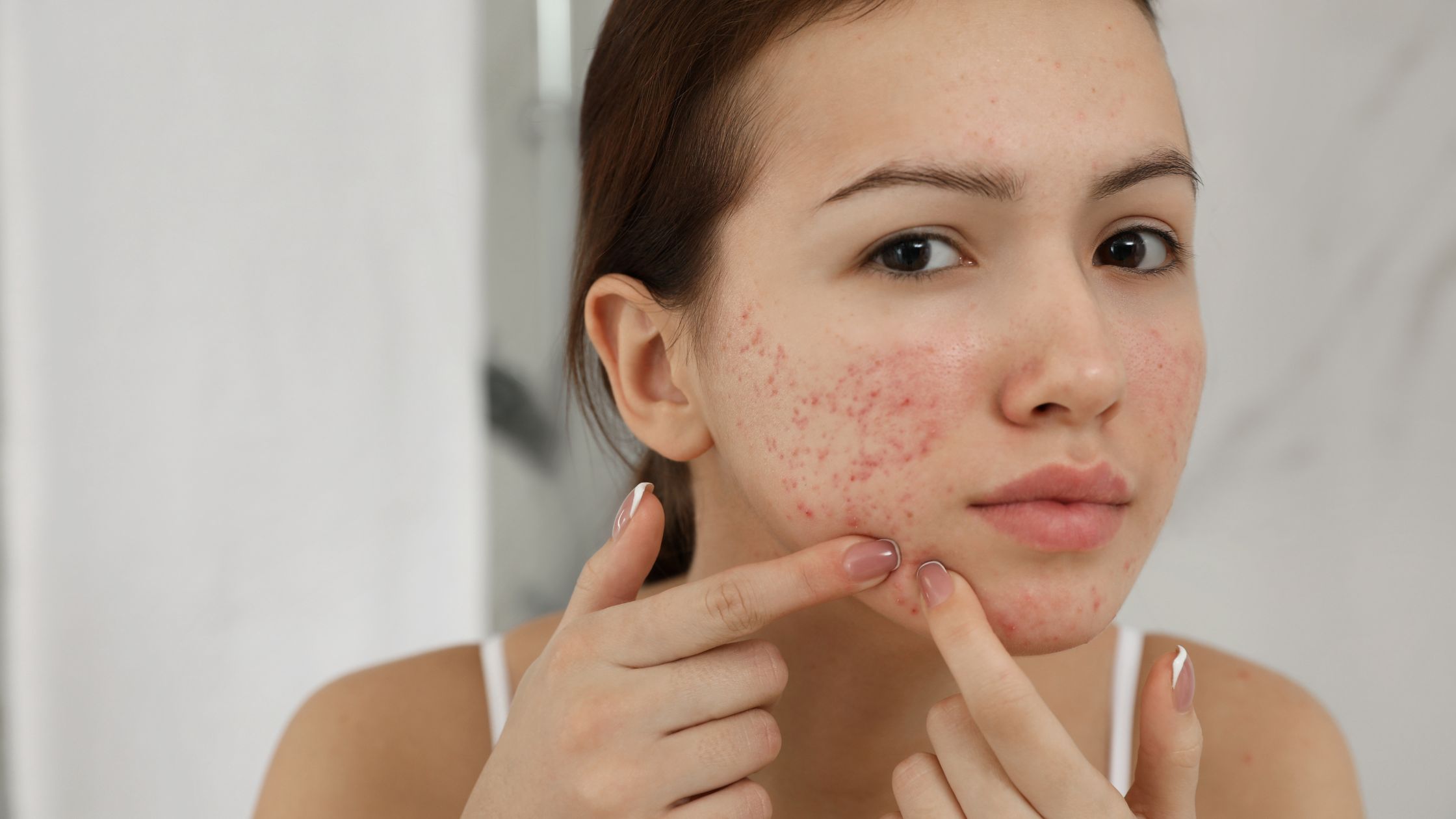 Acne care discount