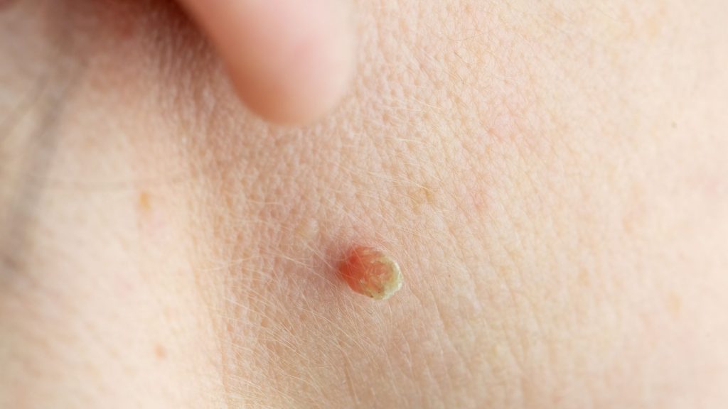 Skin tag removal