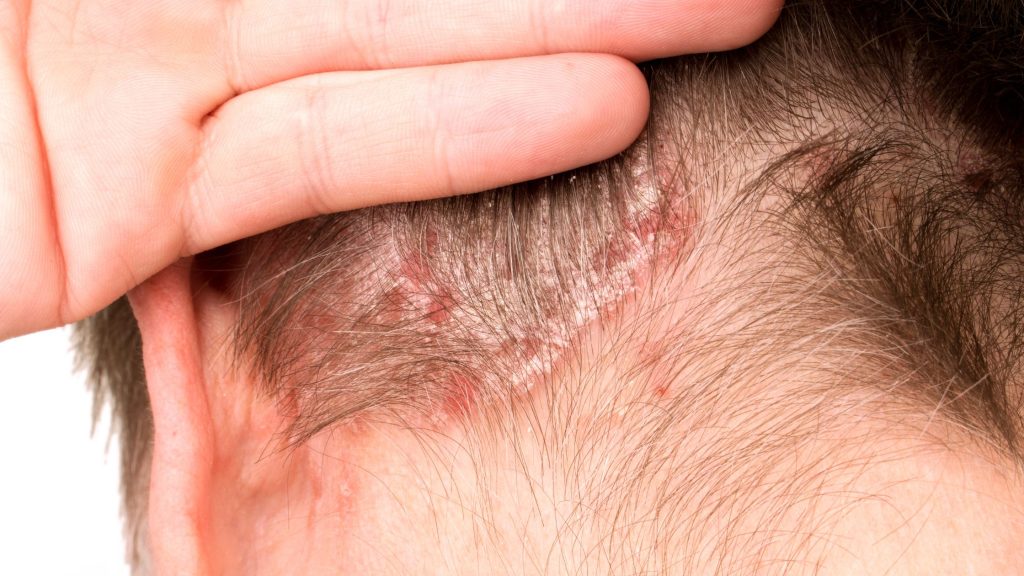 Scalp psoriasis